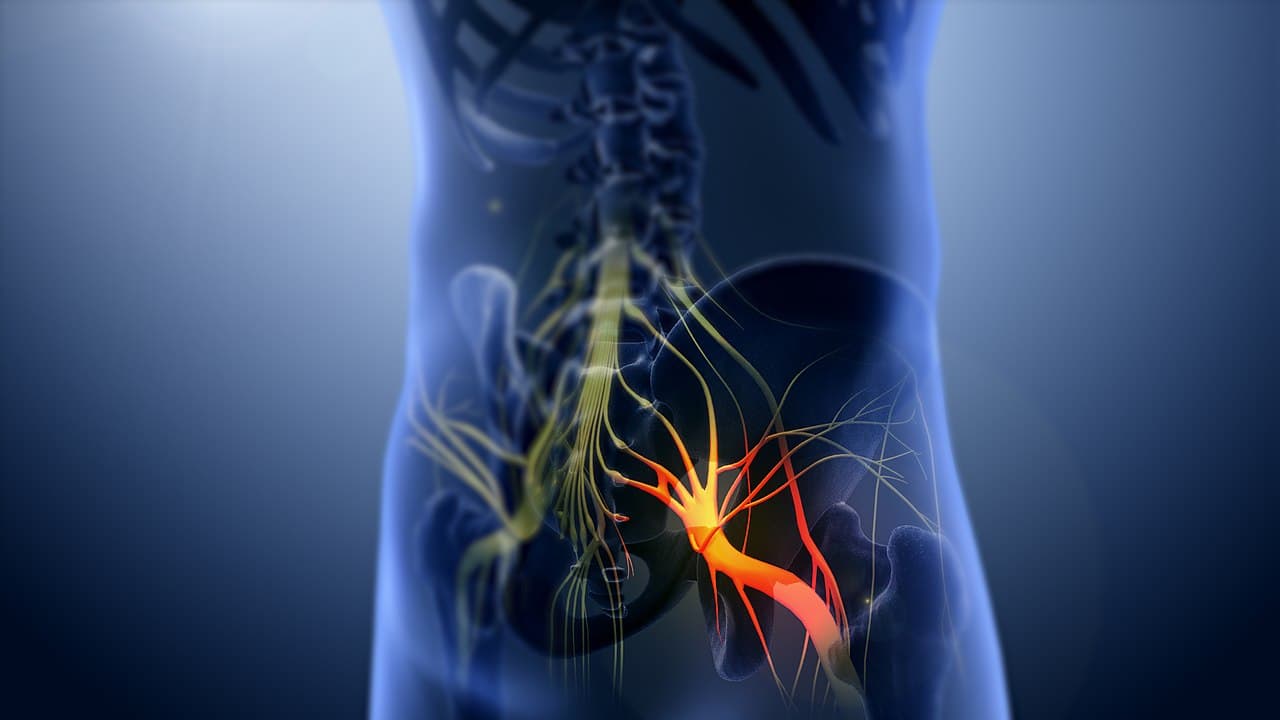 Cryotherapy: Relief for Sciatica Pain