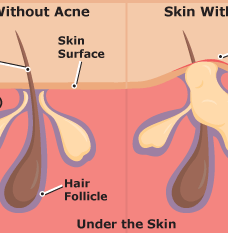 acne graphic