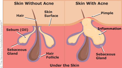acne graphic