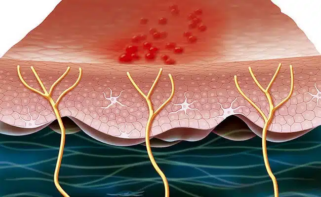 Relieve Shingles Symptoms with Cryotherapy