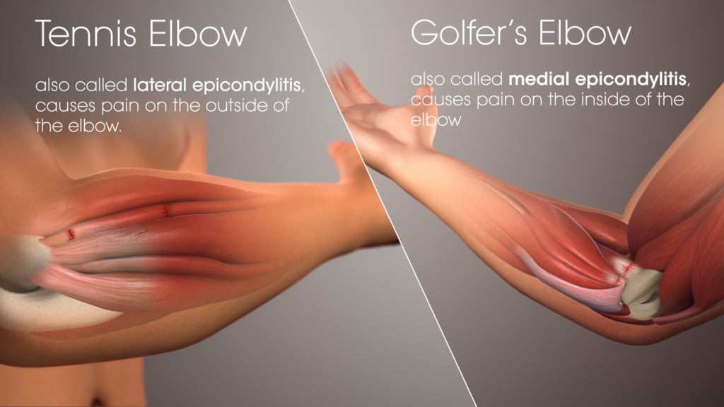 tennis golf elbow