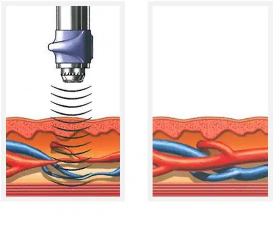 blood flow before after blood flow before after