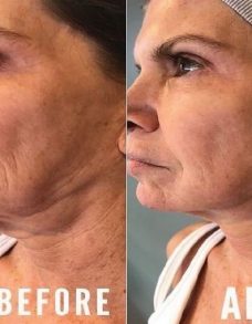 Neck treatment – results after ONE Treatment!