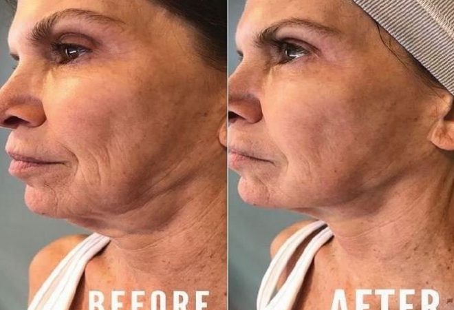 Neck treatment – results after ONE Treatment!