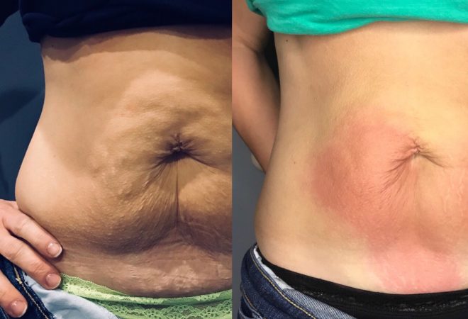 abdominal skin tightening without text