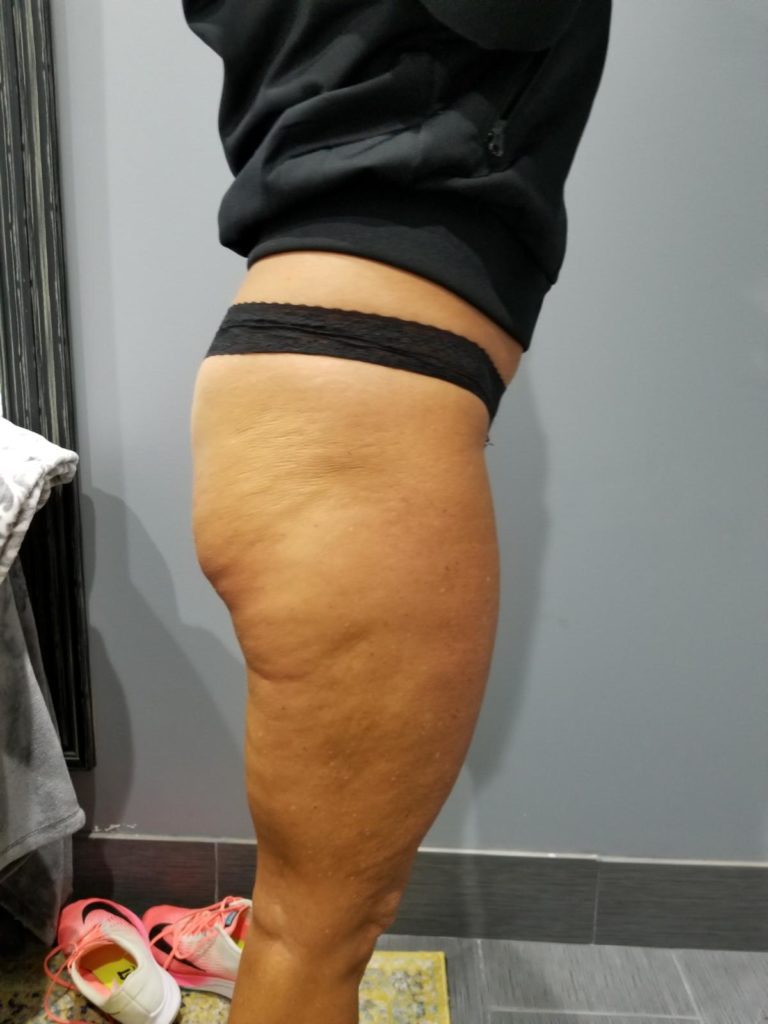 butt & back of leg before