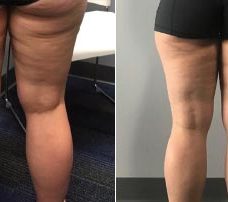 Thigh treatment for fat and cellulite: ONE TREATMENT!!