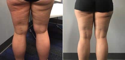 Thigh treatment for fat and cellulite: ONE TREATMENT!!