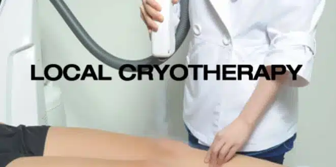 Local Cryotherapy Local Cryotherapy